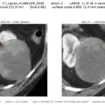 Transforming a Single RECIST Line into a 3D Tumor Segmentation Mask: Inside the Lumina System