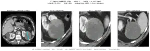 Transforming a Single RECIST Line into a 3D Tumor Segmentation Mask: Inside the Lumina System
